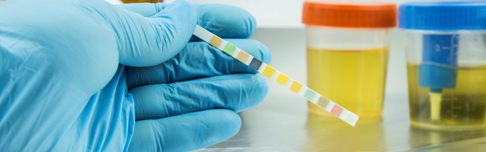 gloved hand with test strip and urine samples